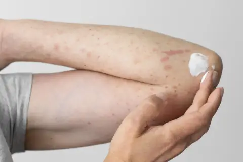 Arm mit roten Flecken und Creme, deutet auf einen **pollenallergie ausschlag** hin.